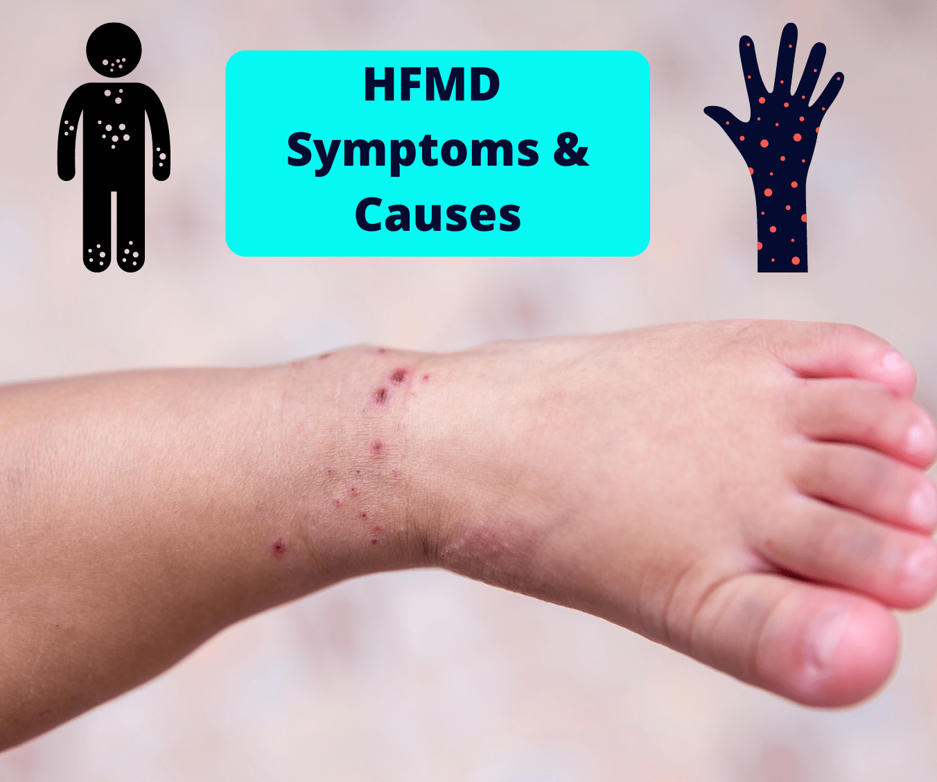 hfmd-symptoms-causes-hand-foot-and-mouth-diseases-hfmd-in-children